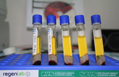 PRP Platelet Rich Plasma Injections - Separation Tubes